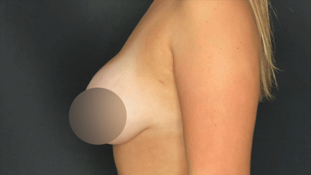 Breast reduction — before & after