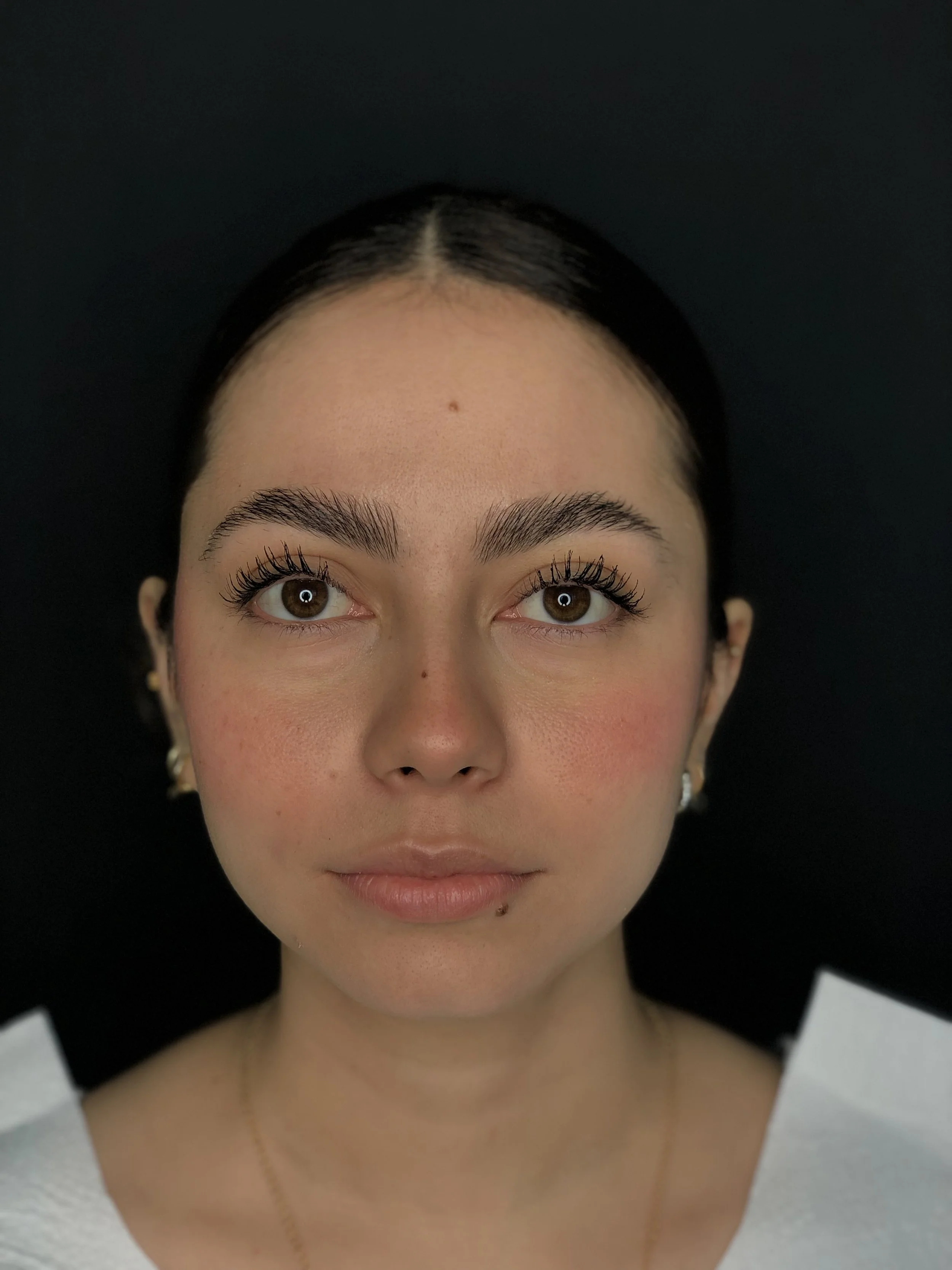 Buccal Fat Removal — Before