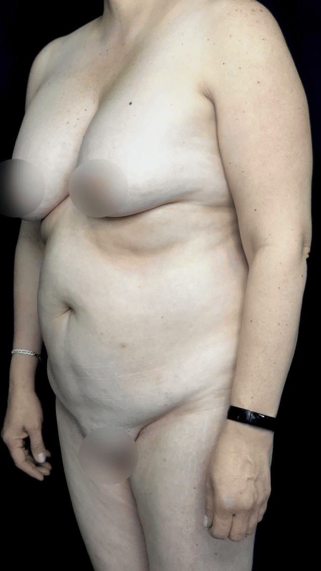 Mommy Makeover — Mommy makeover — before & after