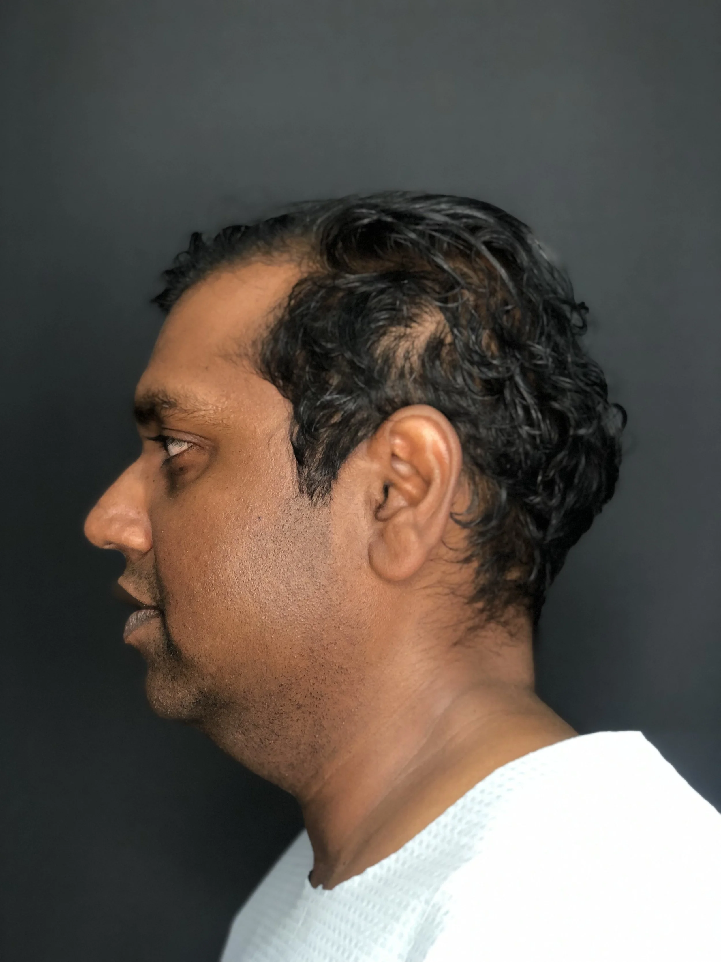Cosmetic Surgery for Men — Submental liposuction — before