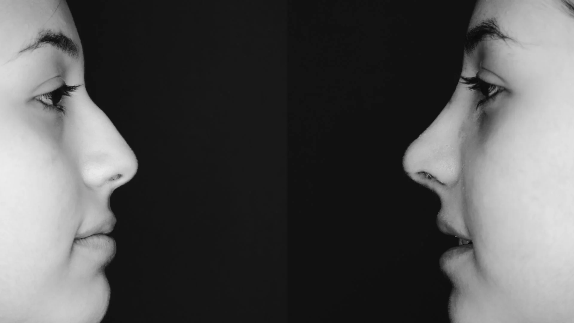 Rhinoplasty — Profile — before & after