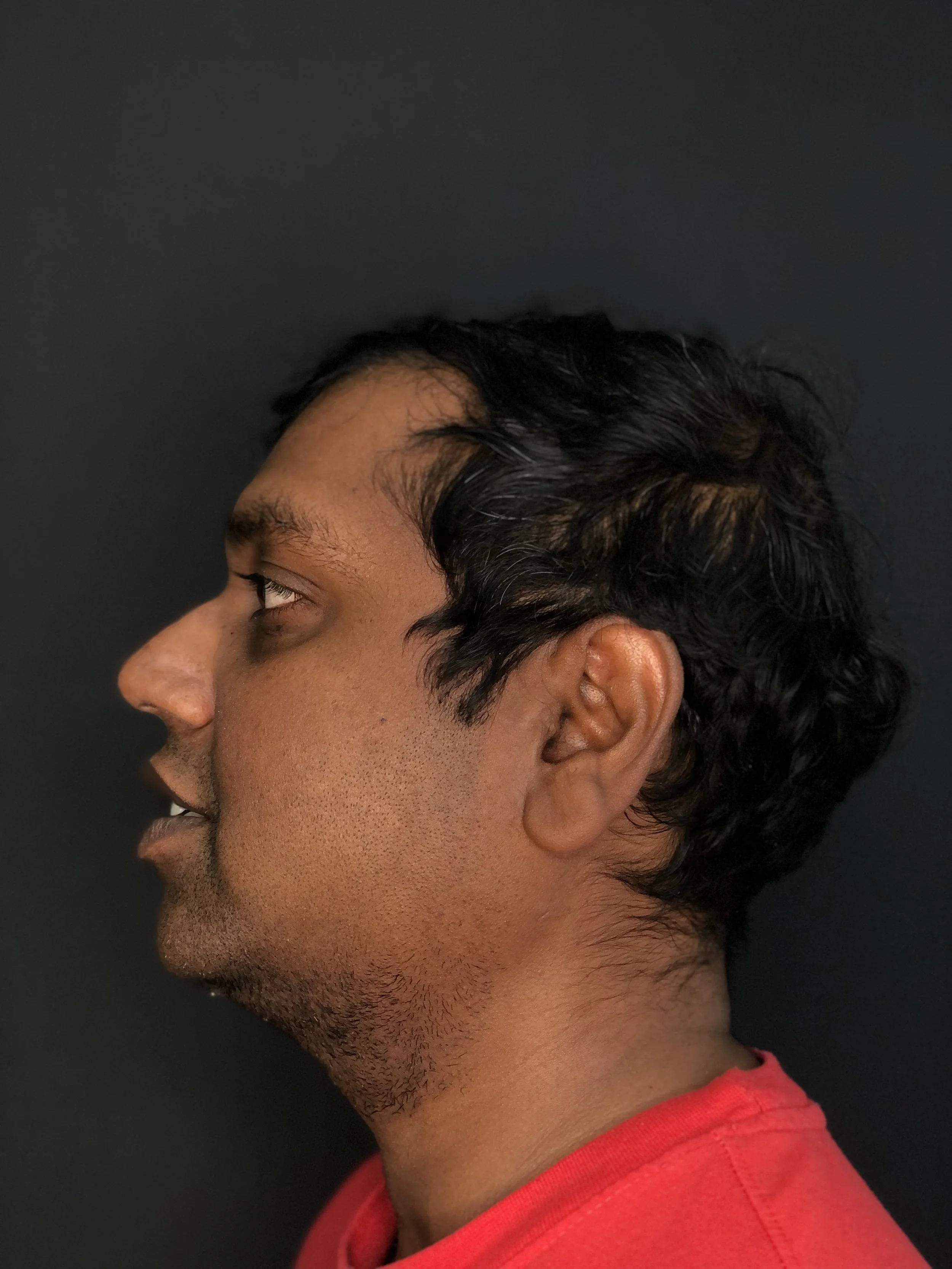 Cosmetic Surgery for Men — Submental liposuction — after