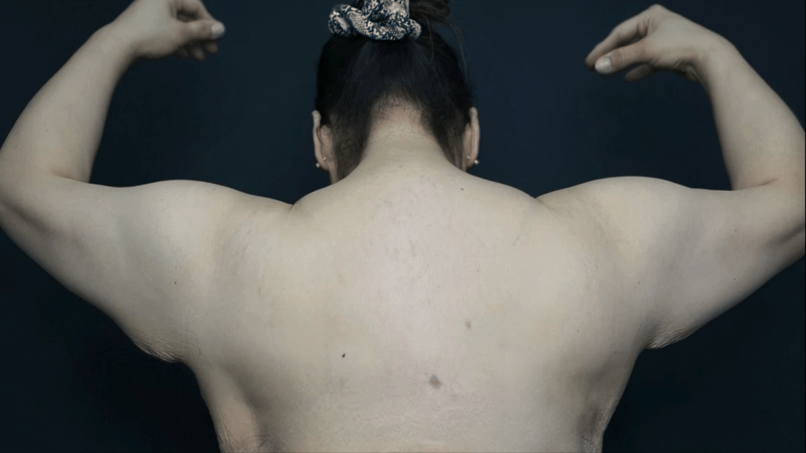 Arm Lift — Arm lift — before & after