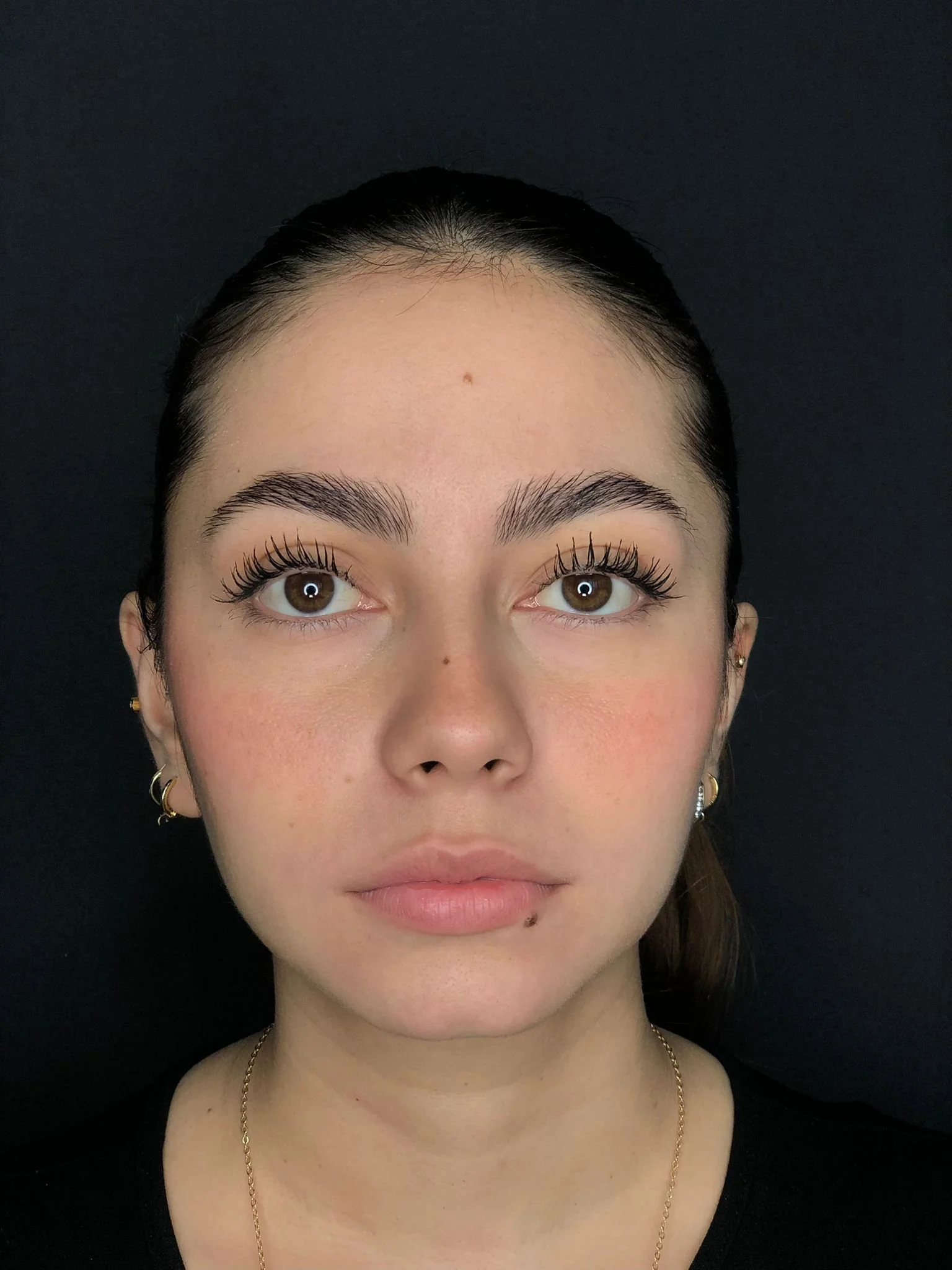 Buccal Fat Removal