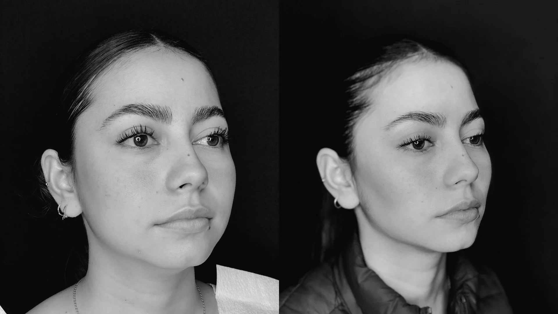 Buccal Fat Removal — Three-quarter view — before & after
