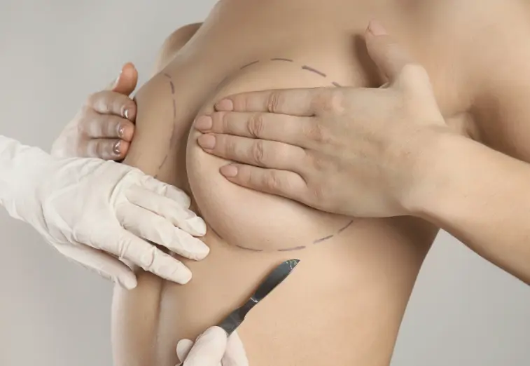Breast augmentation consultation with pre-surgical markings