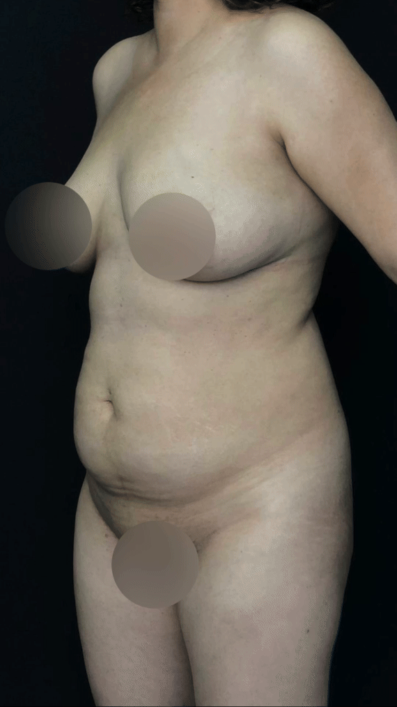 Tummy Tuck — Tummy tuck — before & after