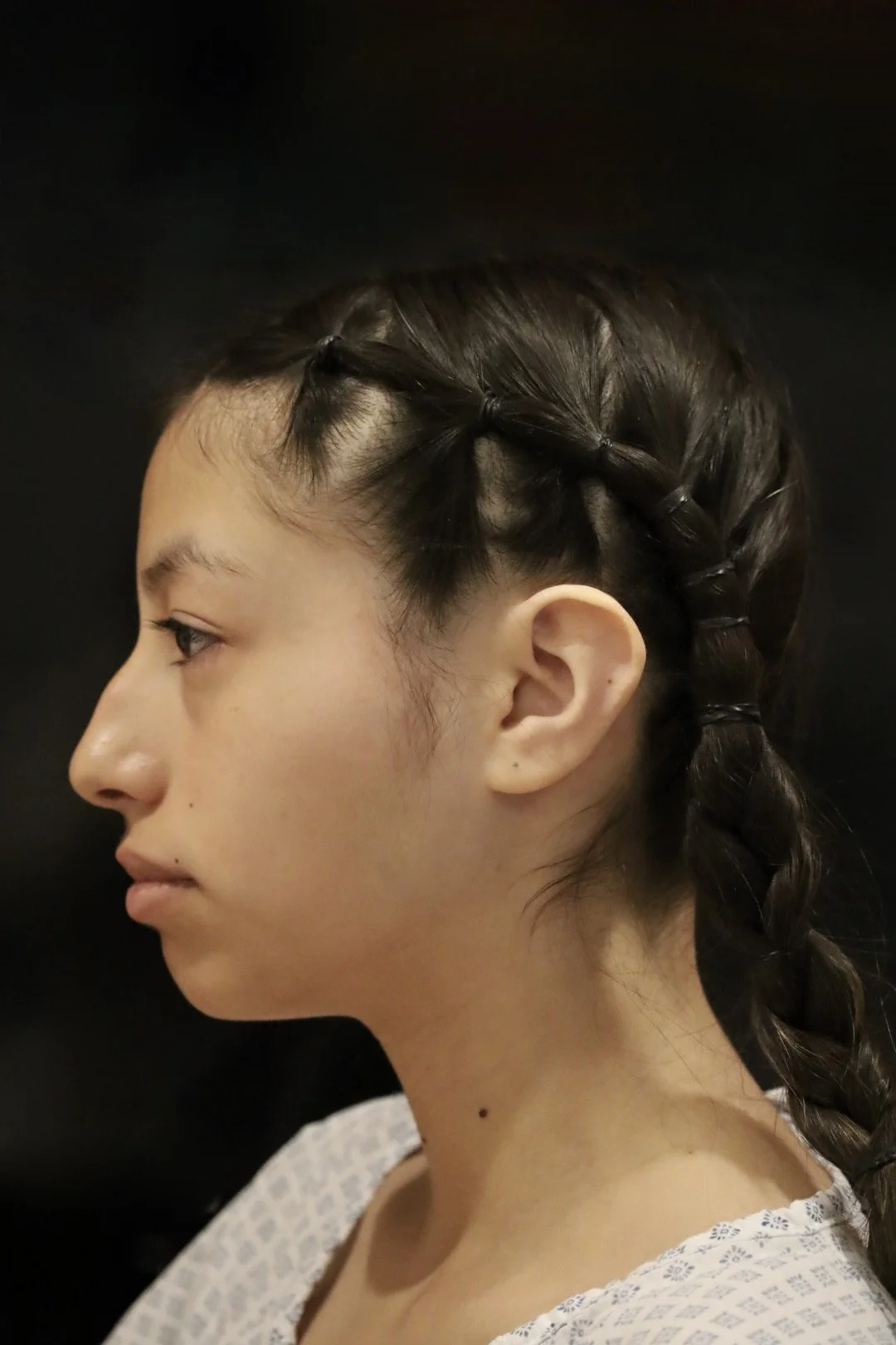 Chin Surgery — Rhinoplasty + chin implant — before & after