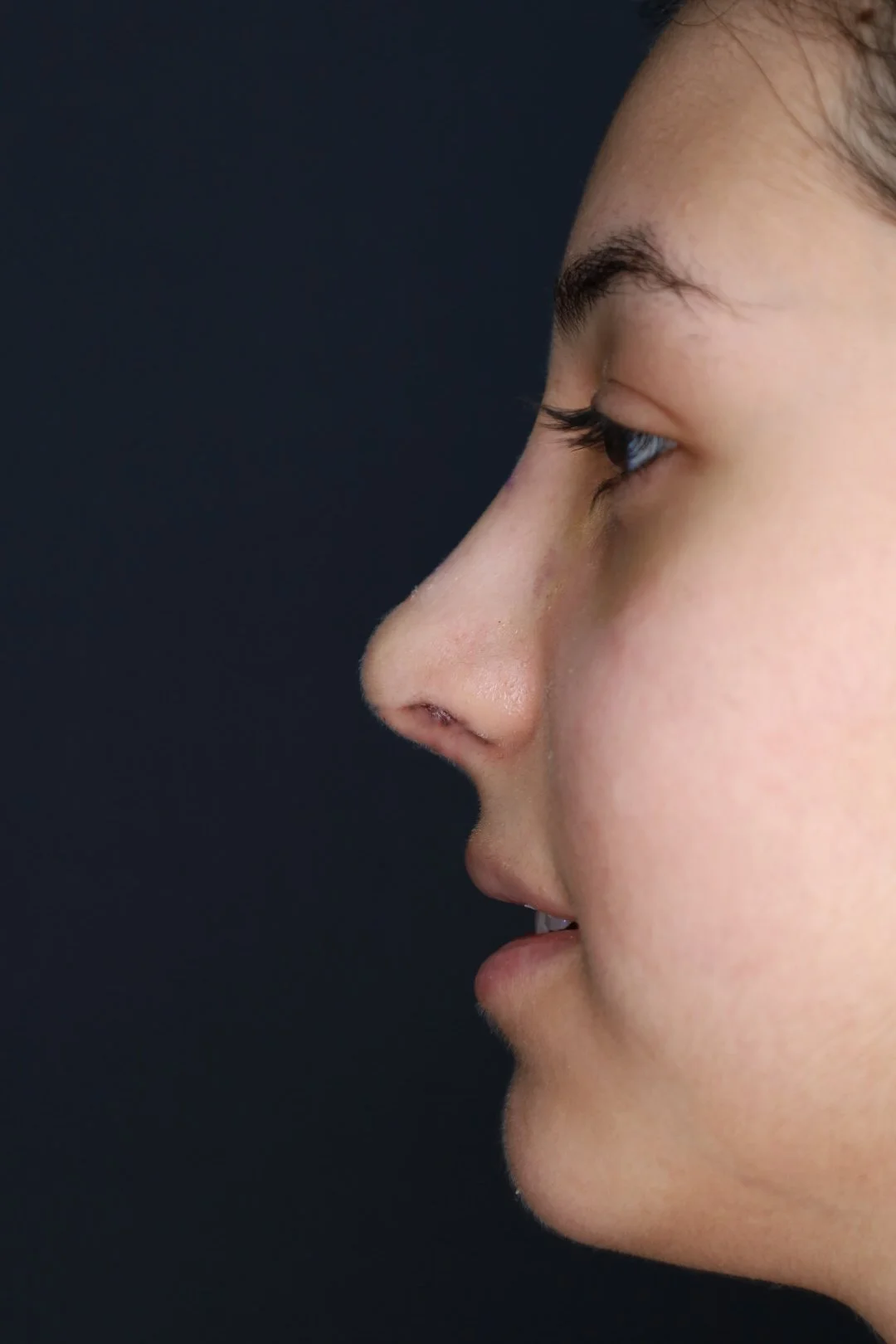 Rhinoplasty — Profile — after (early healing)