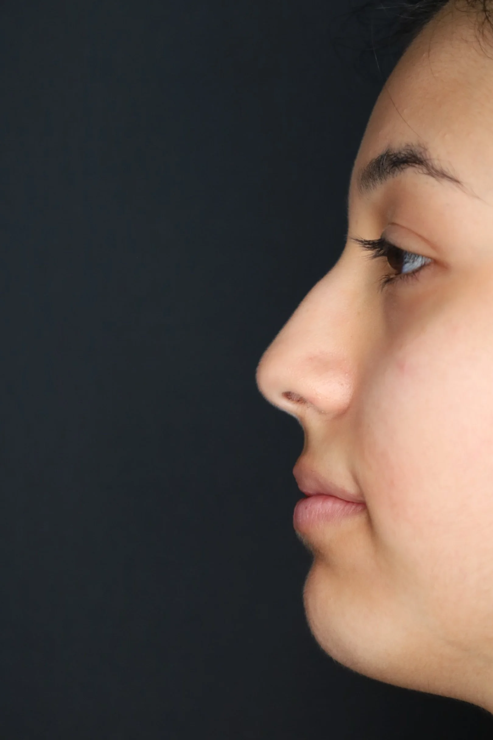 Rhinoplasty — Profile — before