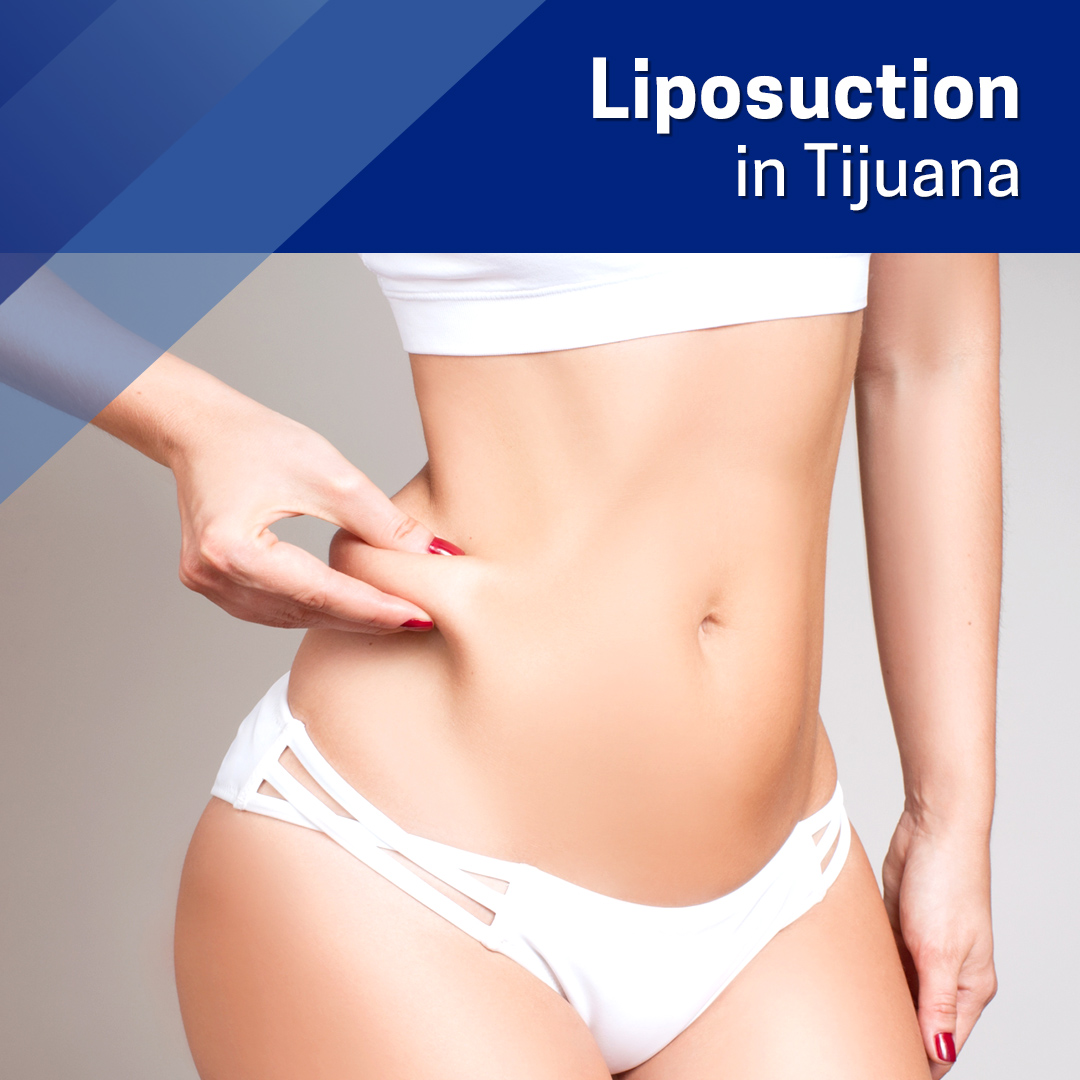 Chin liposuction in Tijuana